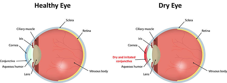 Dry Eye Diagram